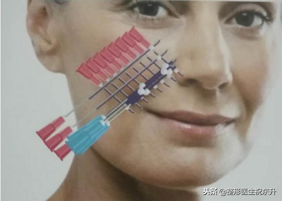 年龄大了想祛法令纹又不想动刀,泪沟法令纹不用动刀就能掩盖掉