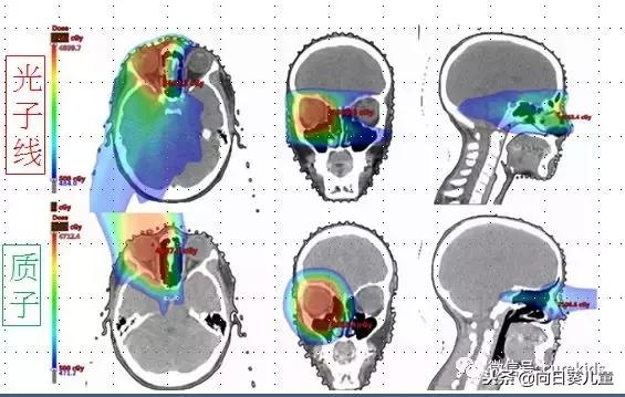 质子治肿瘤怎么样,儿童肿瘤质子治疗好吗
