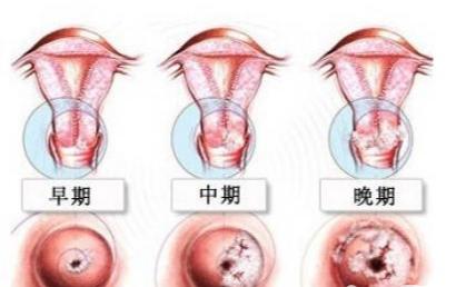 宫颈癌前病变三级治疗费用多少,北京治疗宫颈癌前病变的老中医