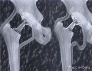 髋关节置换的潘多拉魔盒——术后下肢长短的几种特殊情况
