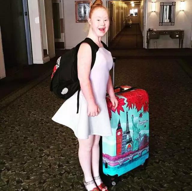 唐氏综合征中国美女,患有唐氏综合征的维密模特