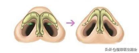 鼻翼缩小鼻骨内推手术,宽鼻头缩窄手术好做吗