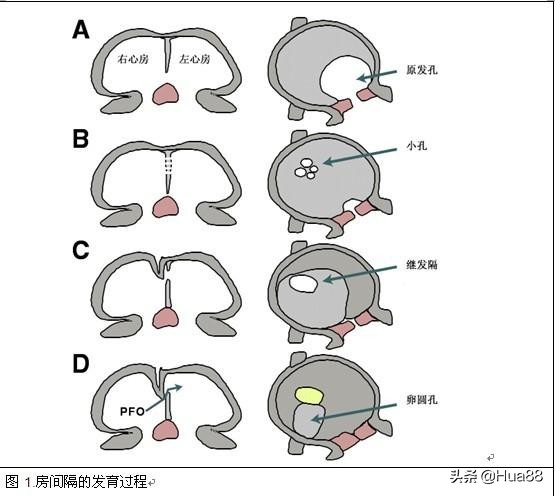 早产儿心脏卵圆孔未闭,卵圆孔未闭的原因