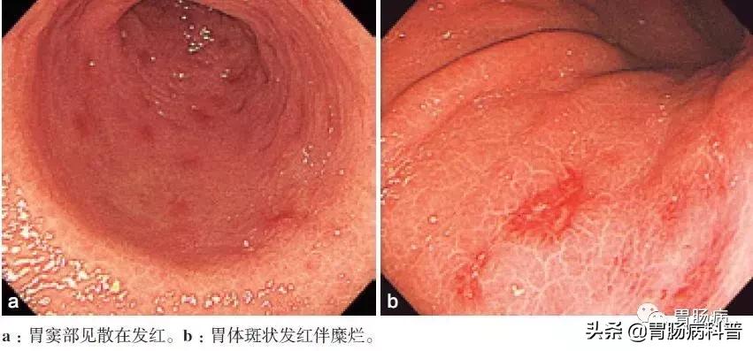 慢性浅表性非萎缩性胃窦炎,浅表性胃炎与慢性非萎缩性的区别