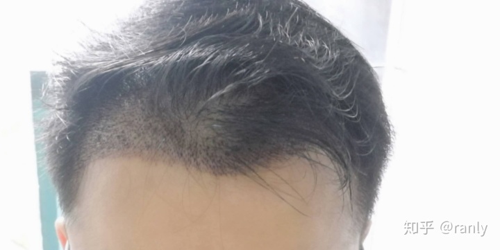 植发日记是什么,植发日记vlog第六天