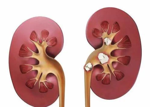 吃什么容易得肾结石都应该注意啥,肾结石应注意哪些饮食习惯