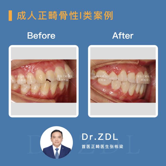 骨性龅牙做正畸还是正颌,骨性龅牙正颌手术前要正畸吗