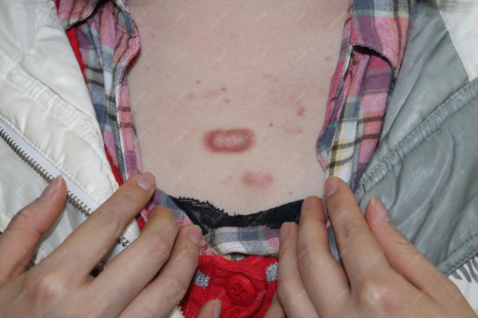 北京疤康怎么治疗疤痕,疤康医院治疗疤痕增生如何