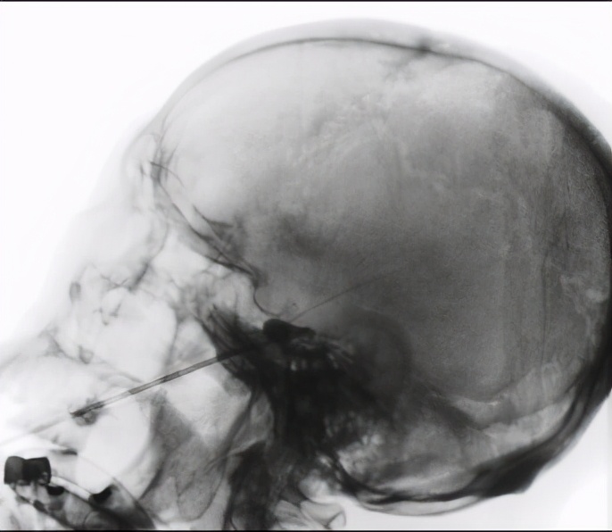 一针疗法治偏瘫有效果吗,帕金森手抖一针见效多久恢复