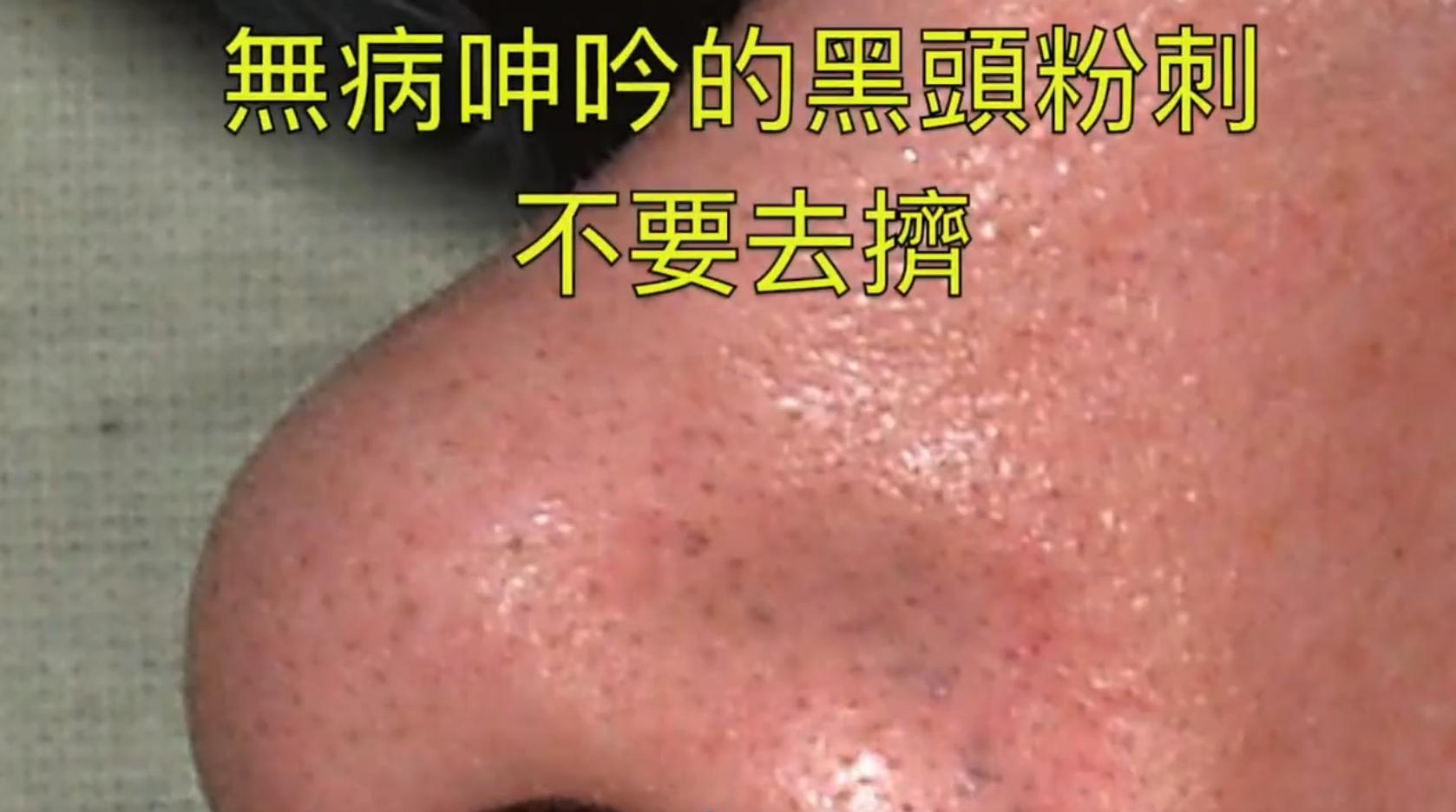 掏耳屎挤黑头粉刺清理毛孔有用吗,黑头粉刺到底要不要挤出来