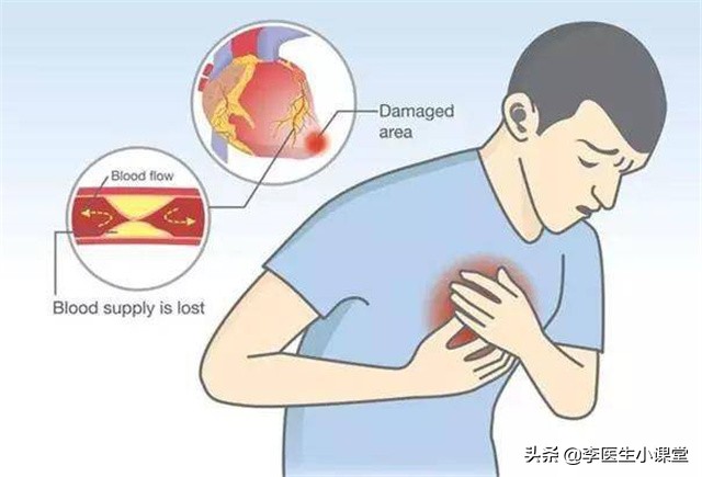 48岁心肌梗死不支架可以吗,35岁得心梗没放支架恢复很好