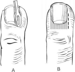 解决甲沟炎比较好的方法,甲沟炎很严重怎么修