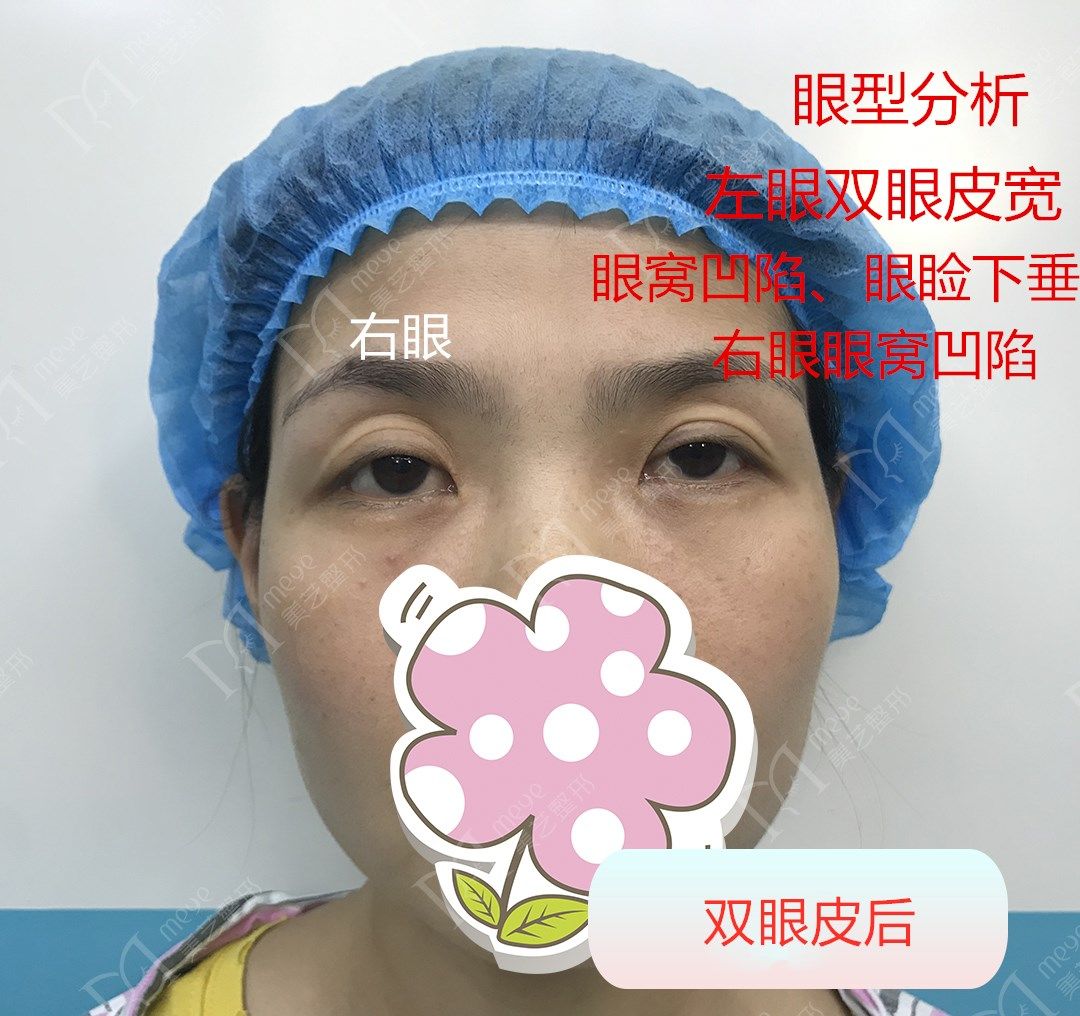 为什么有人割了双眼皮反而不好看,为啥有些人割了双眼皮变化巨大