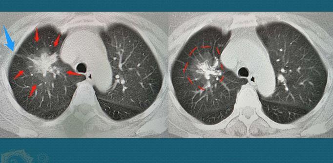 听诊器能听出早期肺癌吗,医生听诊器能听出肺癌吗