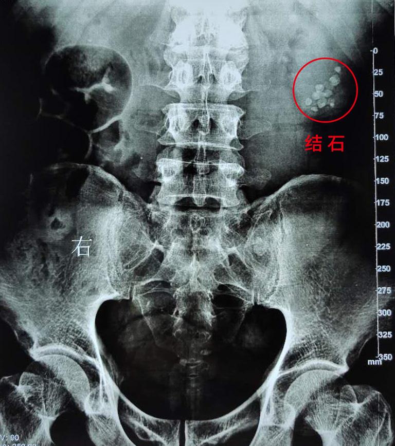 结石体质怎么改善,结石体质到底是哪里代谢出了问题