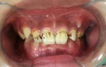 牙齿发黑是什么原因,宝宝牙齿发黑了怎么办