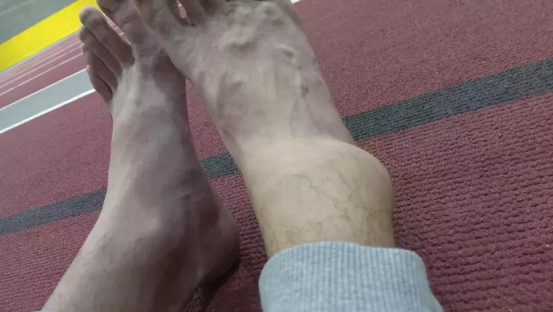 中国留学生被截肢,励志留学生