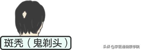 脱发掉发人福音来了,脱发人数2亿