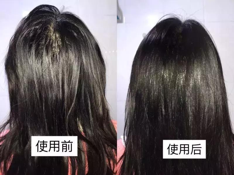 头发毛躁并且脱发推荐洗发水,用什么洗发水改善头皮脱发