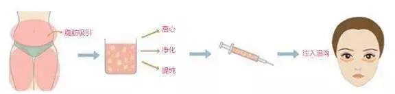 眼袋怎么消除简单方法男生,黑眼袋怎么消除最快方法男士