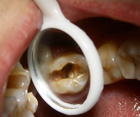 牙齿变黑刷不掉是蛀牙吗,牙齿变黑还能医好吗