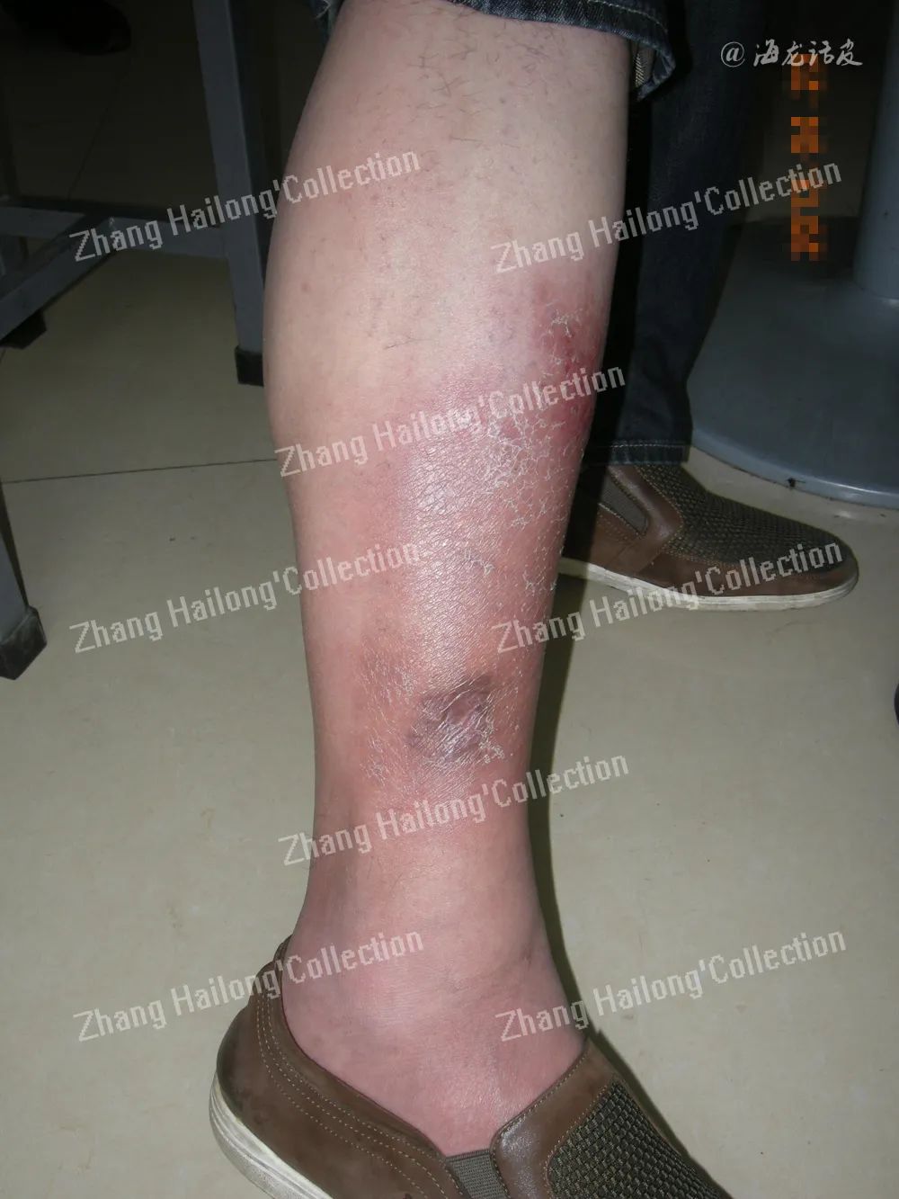 足癣和丹毒的区别,足癣和脚气一样吗