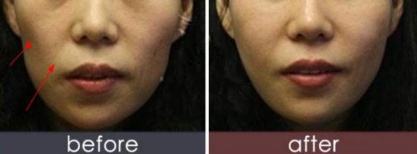 法令纹苹果肌下垂有什么办法改善,如何改善法令纹和苹果肌下垂