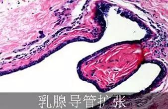 乳腺管增粗有什么危害,乳腺导管扩张是怎么回事