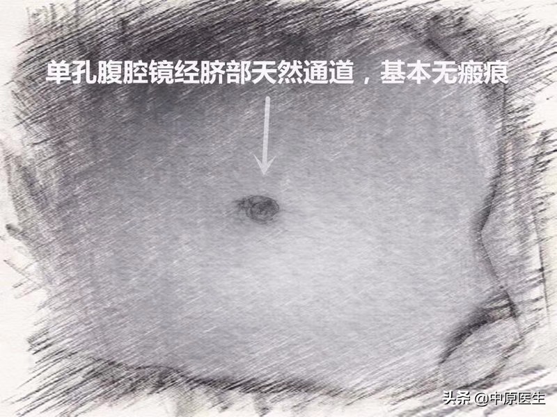 一个切口的阑尾炎手术,阑尾炎微创肚脐部位有个洞