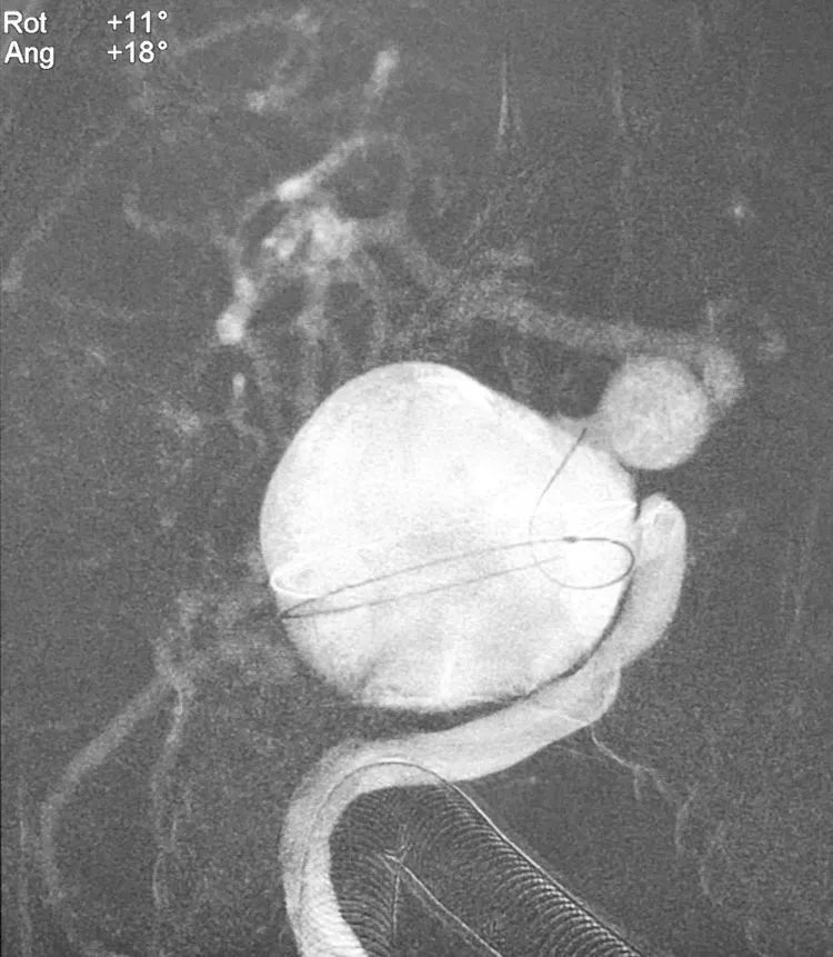 国外怎么治疗动脉瘤,全世界颅内动脉瘤最佳的治疗