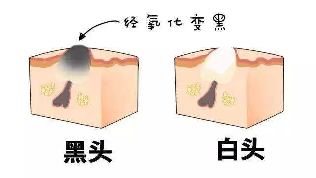 皮肤科医生怎么处理黑头,皮肤科医生怎样去黑头粉刺最简单