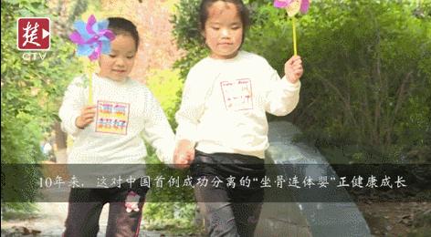 坐骨连体双胞胎多大分离,中国首例坐骨婴儿手术成功完整版