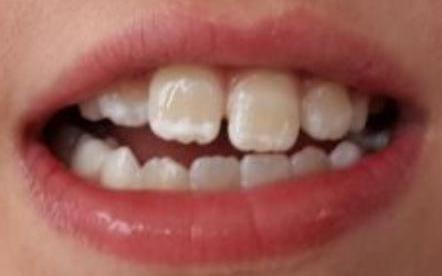 用完牙贴牙齿出现了白斑怎么回事,牙齿出现白斑要注意补钙还是防蛀