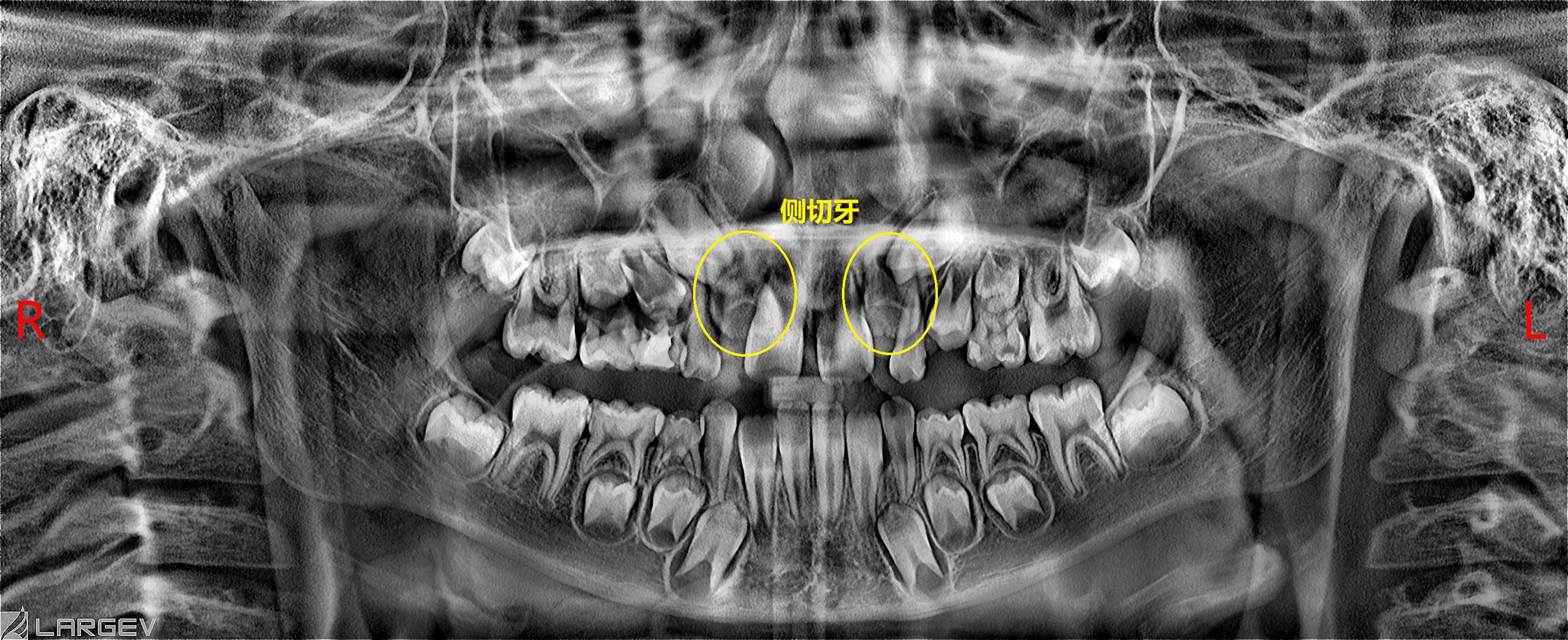 门牙中间为什么有缝隙,门牙中间有缝咋回事