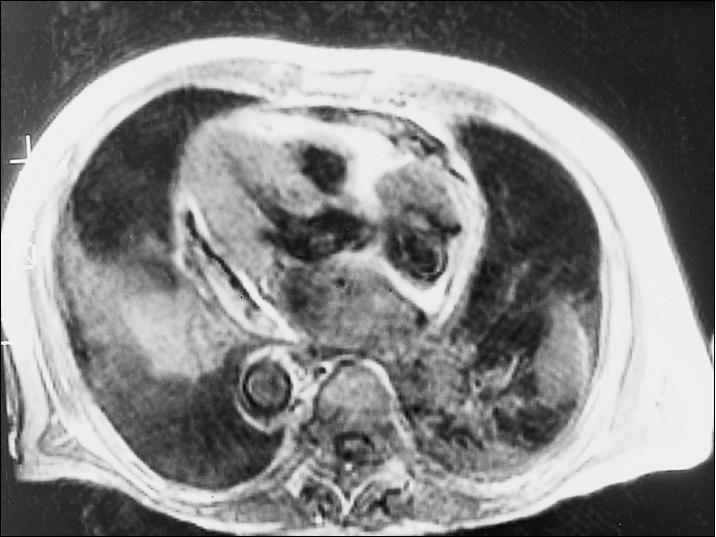 类风湿关节炎能引起心脏疾病吗,类风湿心脏病自愈的最简单方法