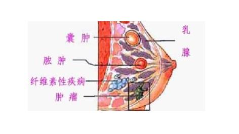 乳房纤维腺瘤手术后多久复诊,乳房纤维腺瘤是雌激素太高吗