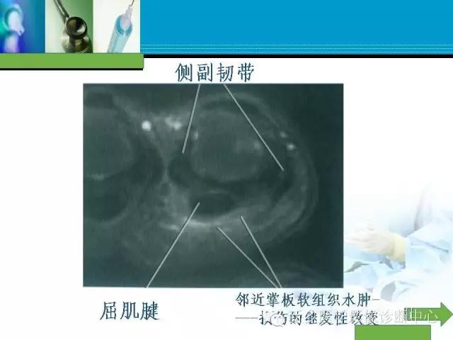 单只手指磁共振,手指用磁共振能做出来结果吗