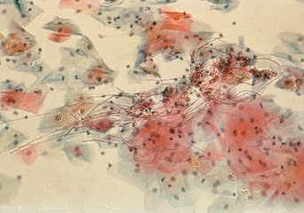 宝宝鹅口疮的症状和护理方法,鹅口疮的基本知识