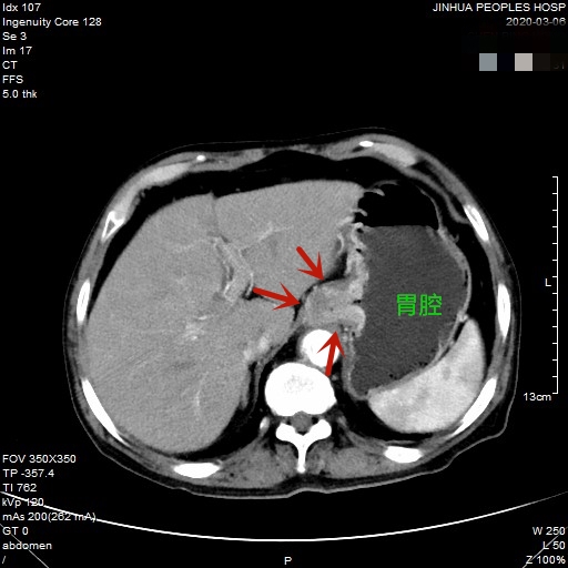 贲门癌80岁手术好还是保守治疗好,医生建议80岁老人做贲门癌手术