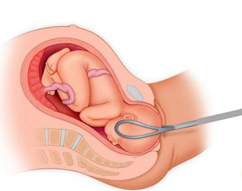 产钳夹过的孩子的图片,被生产钳夹出来的孩子