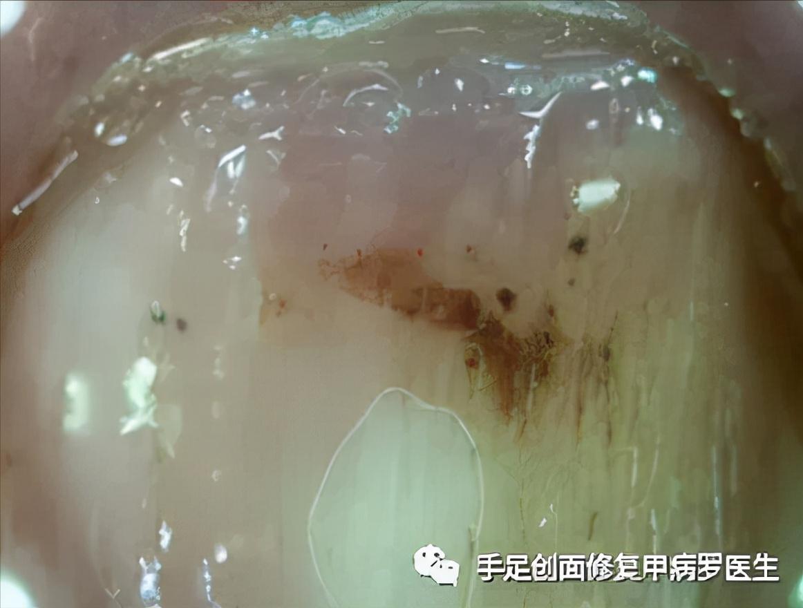 甲下积血放血后如何止血,甲下积血怎么办