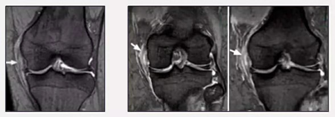 膝关节内侧副韧带损伤症状,膝关节副韧带损伤恢复训练