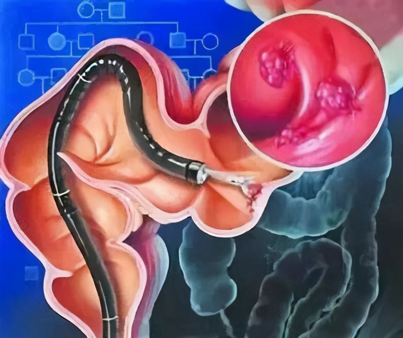 便秘溃疡性结肠炎怎么治疗,溃疡性结肠炎小腹疼痛便秘怎么办