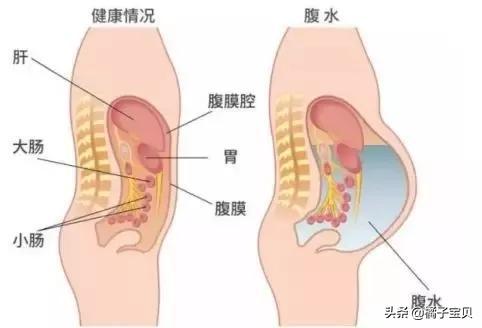 卵巢过度刺激综合征怎么得的,卵巢过度刺激综合征要用白蛋白吗
