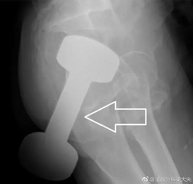 罗非鱼直肠,罗非鱼塞进直肠多长时间