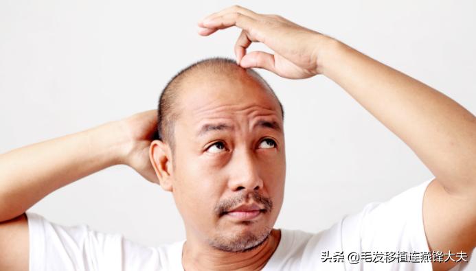 毛囊脱发怎么治疗最有效,治疗脱发有什么办法吗