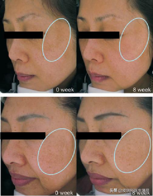 黄脸婆吃什么祛斑,告别黄脸婆自制纯中药祛斑面膜