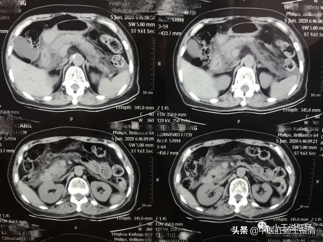 突发胰腺炎需治疗多少天,突发胰腺炎死亡率大不大
