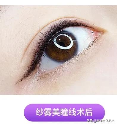 眼睛戴美瞳有血丝红肿怎么办,眼睛戴了美瞳红肿一碰就痛