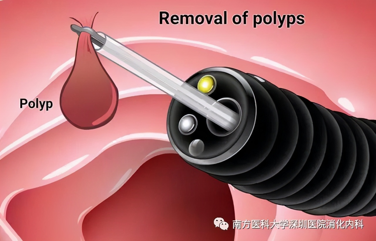 肠镜息肉摘了后要随访吗,切了肠道息肉还用复查吗